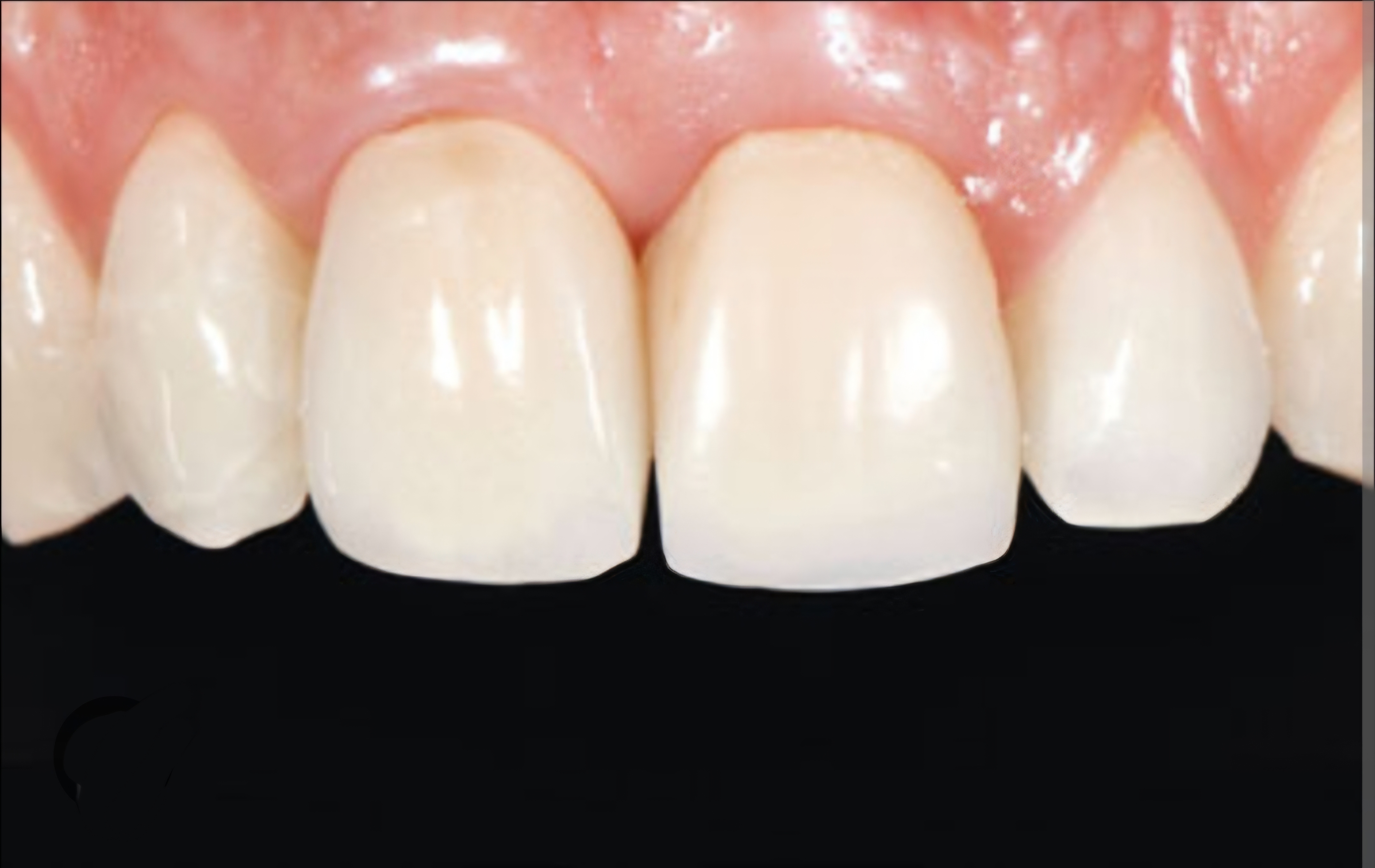 Acrylic & Temporary Solutions